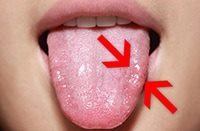 Лечение молочницы на языке у взрослых