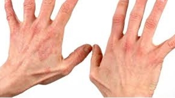 Грибок на руках: симптомы и эффективное лечение
