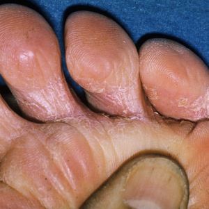 Грибок между пальцами ног: лечение в домашних условиях и народными средствами