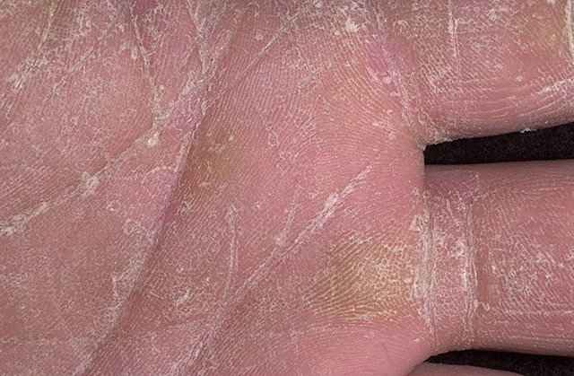 Противогрибковые мази для кожи - самые эффективные
