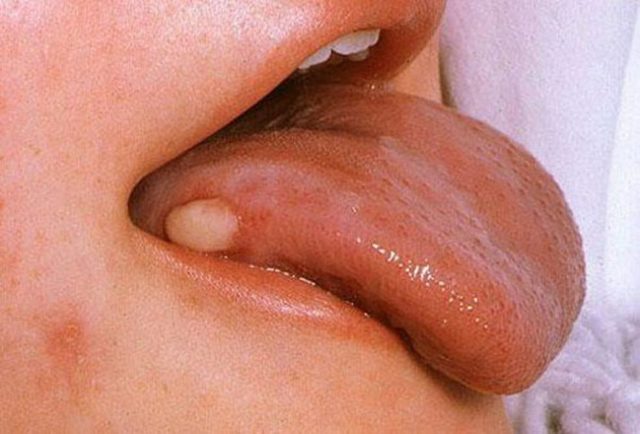 Бородавки во рту - на языке, губах и деснах - как избавиться