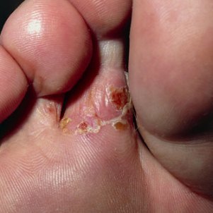 Грибок между пальцами ног: лечение в домашних условиях и народными средствами
