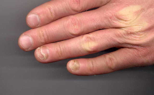 Грибок ногтей: начальная стадия - как выглядит