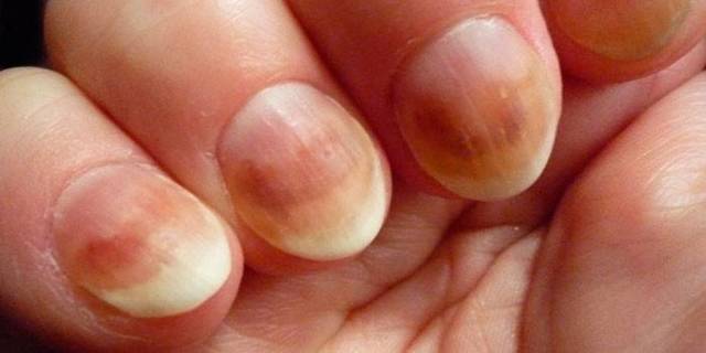 Как лечить кандидоз ногтей?