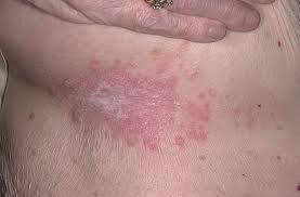 Кандидоз кожи - симптомы и лечение