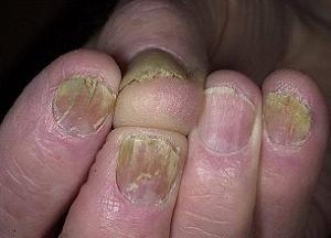 Средства от грибка ногтей на руках: эффективные препараты