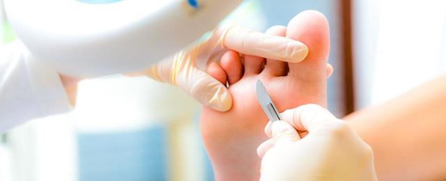 Бородавки на ногах - причины появления и лечение