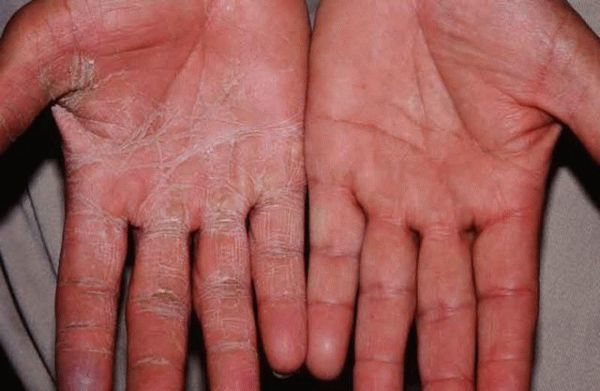 Грибок на руках: симптомы и эффективное лечение