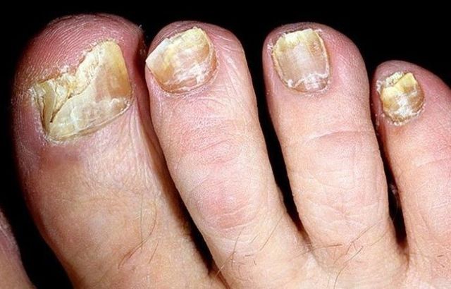 Чеснок от грибка ногтей на ногах - как лечиться?