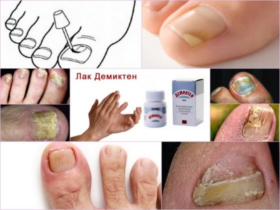 Демиктен: лак от грибка ногтей - отзывы, цена, аналоги