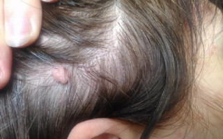 Папилломы на голове, в волосах и на ушах - как их удалить?
