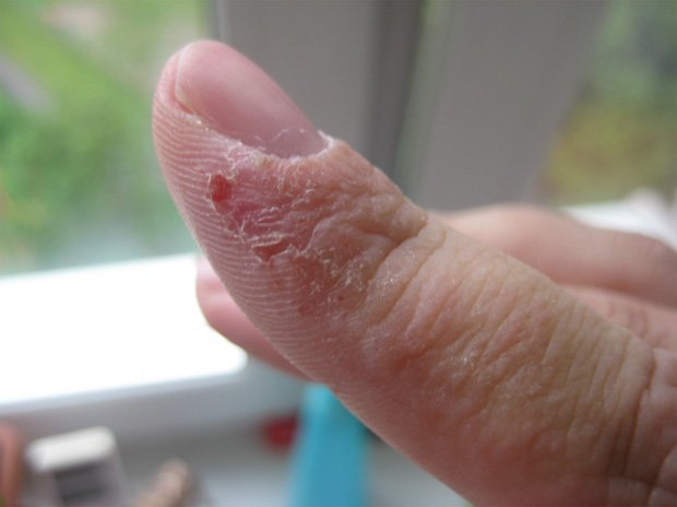 Как отличить грибок ногтей от других заболеваний - псориаза, аллергии, экземы