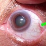 Как лечить кандидоз глаз?