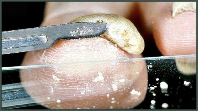 Анализ на грибок ногтей и кожи: лабораторная диагностика микозов