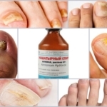 Нашатырный спирт от грибка ногтей на ногах - лечение аммиаком