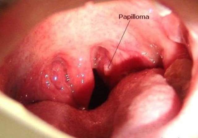 Папилломы мягкого неба во рту: причины образования и лечение