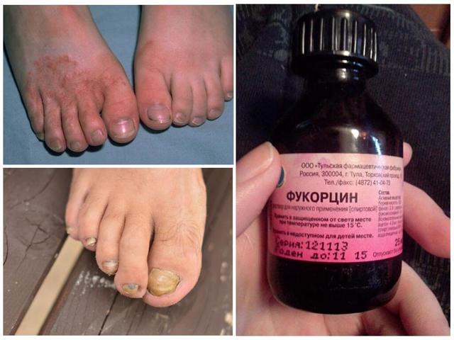 Фукорцин от грибка ногтей на ногах - отзывы о лечении, цена