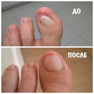 Применение фракции асд 2 и 3 для лечения грибка ногтей
