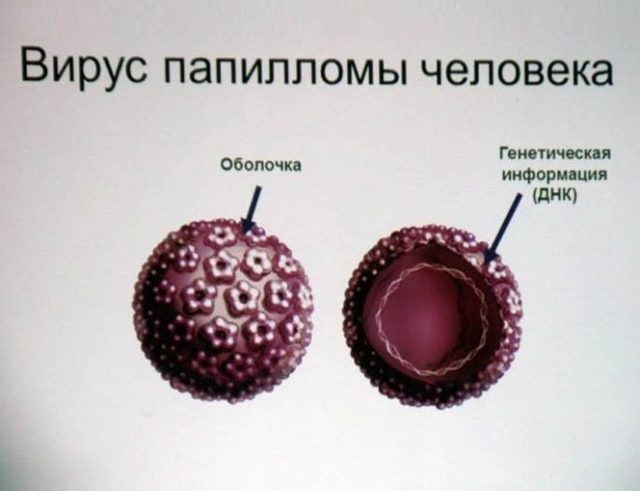 Кондиломы и вирус папилломы человека