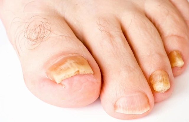 Нашатырный спирт от грибка ногтей на ногах - лечение аммиаком