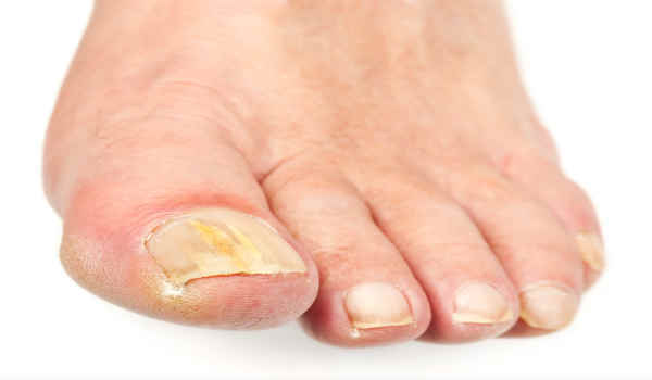 Корень аира от грибка ногтей на ногах - отзывы о применении