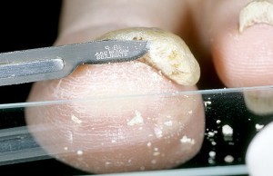 Анализ на грибок ногтей и кожи: лабораторная диагностика микозов