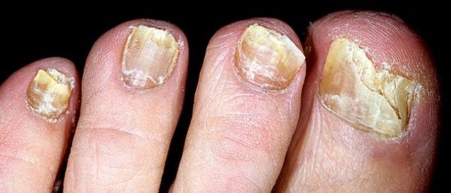 Лечение грибка ногтей луком