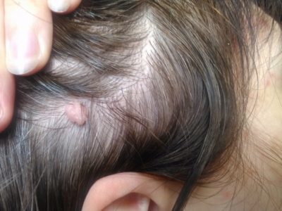 Папилломы на голове, в волосах и на ушах - как их удалить?