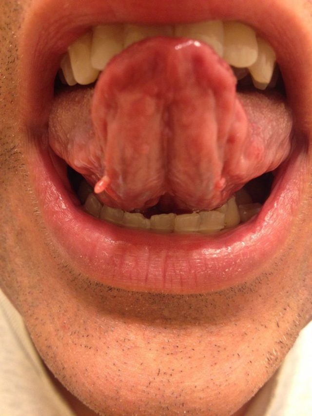 Удаление папиллом в полости рта, на деснах, слизистой и щеках