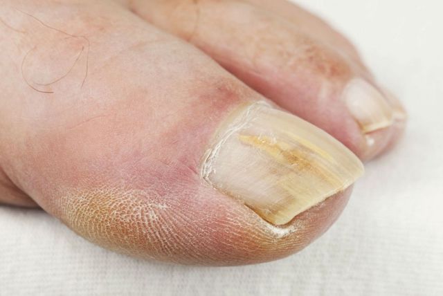 Чем размягчить ногти на ногах при грибке?