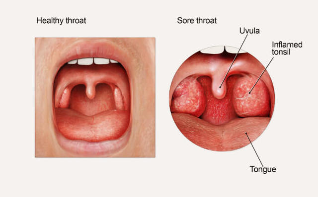 ﻿Кандидоз горла - признаки и лечение