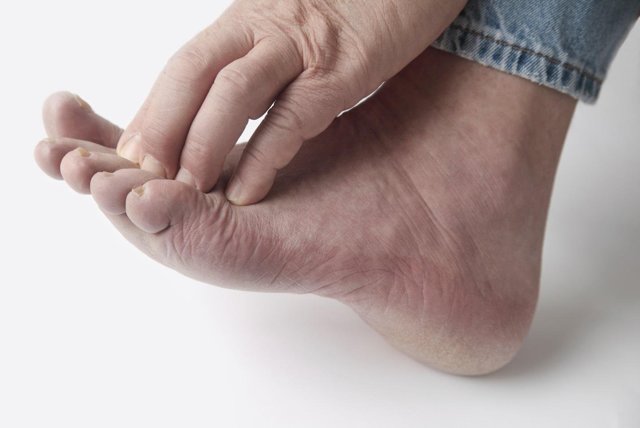 Грибок на ногах - как выглядит и чем лечить в домашних условиях