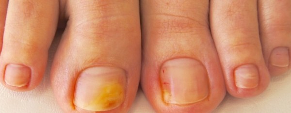 Применение фракции асд 2 и 3 для лечения грибка ногтей