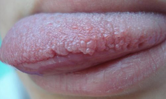 Кондиломы во рту - на языке, на губах и деснах