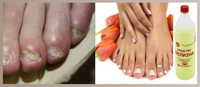 Лечение грибка ногтей белизной - инструкция по применению