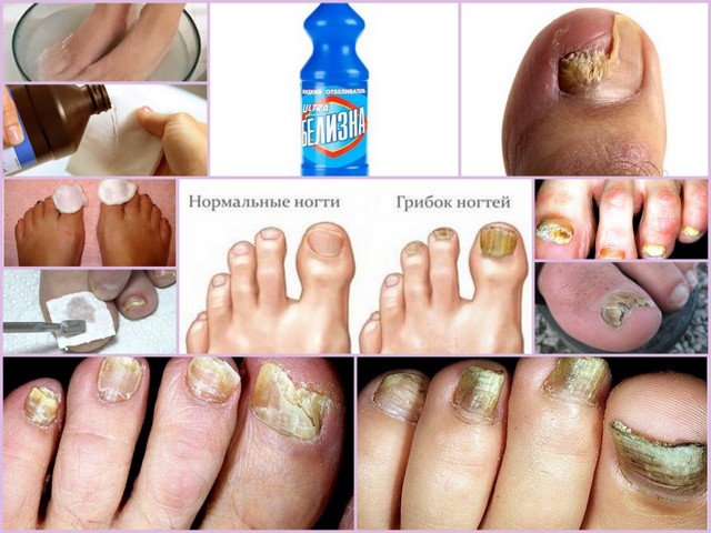 Лечение грибка ногтей белизной - инструкция по применению