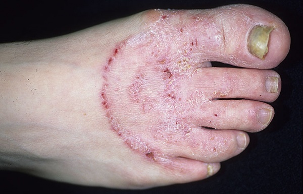 Грибковые заболевания кожи (микоз) - симптомы и лечение