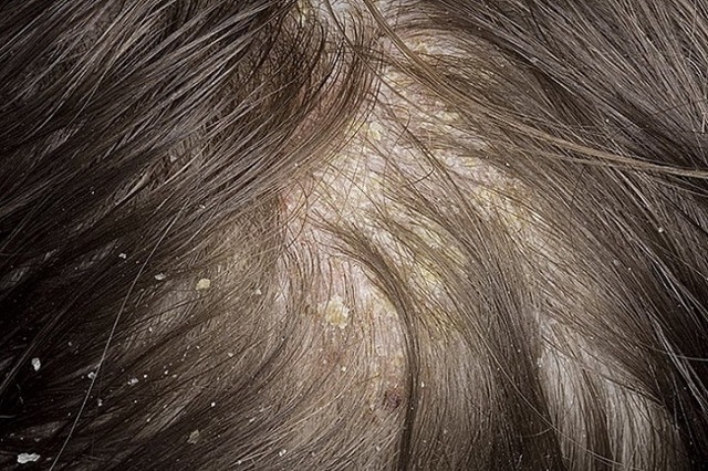 Противогрибковый шампунь для волос