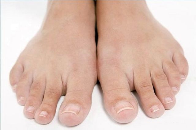 Чем размягчить ногти на ногах при грибке?