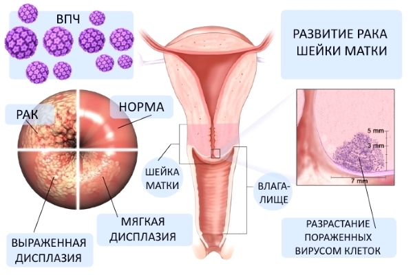 Что такое папиллома у женщин? Признаки и лечение инфекции
