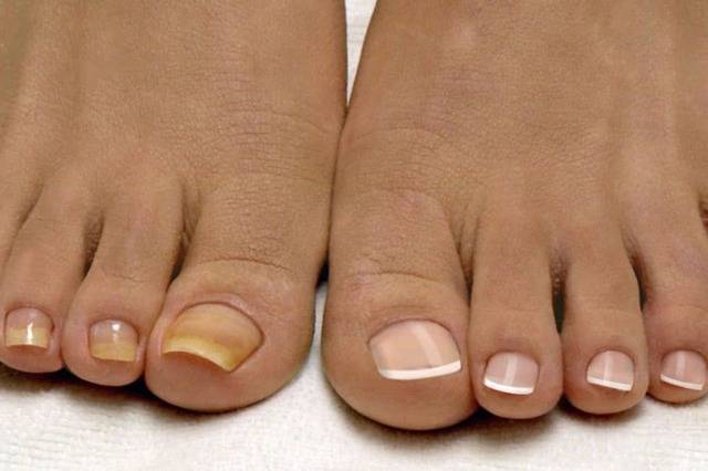 Лечение грибка ногтей керосином и формалином
