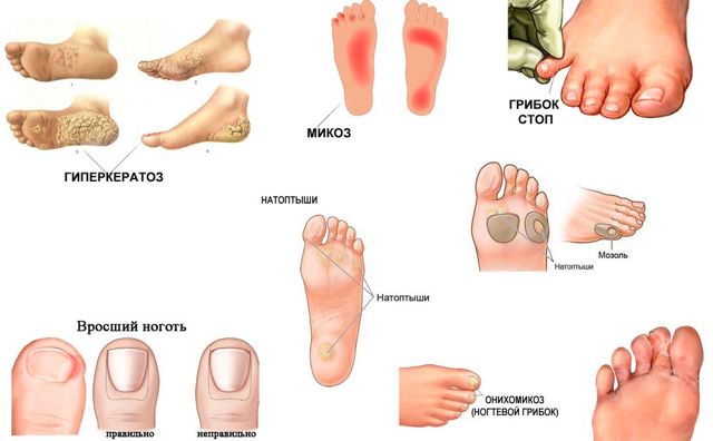 Антибиотики при грибке ногтей на ногах