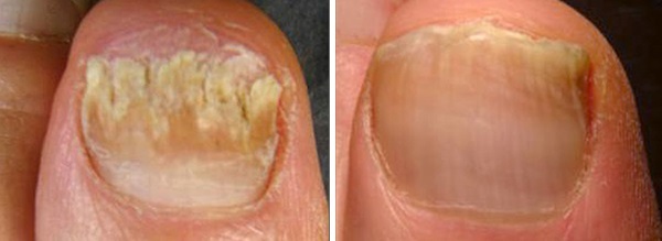 Лечение грибка ногтей (онихомикоза) лазером