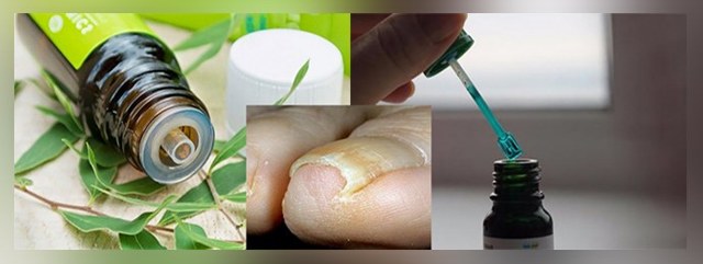 Можно ли вылечить грибок ногтей зеленкой?