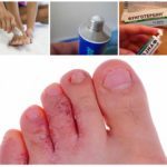 Грибок между пальцами ног: лечение - препараты недорогие, но эффективные