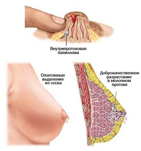Папилломы в области груди: причины появления и способы избавления