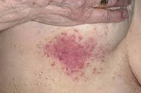 Кандидоз кожи - симптомы и лечение