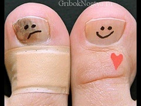 Чем опасен грибок ногтей на ногах если его не лечить?