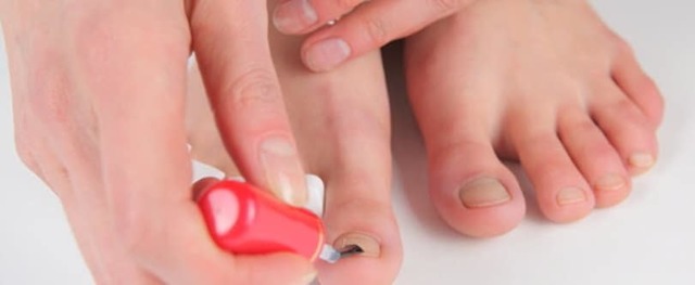 Грибок ногтя на большом пальце ноги и его лечение - 5 способов!