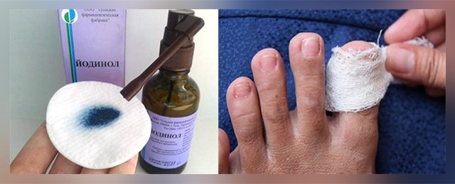 Йодинол от грибка ногтей и стоп - отзывы,инструкция по применению